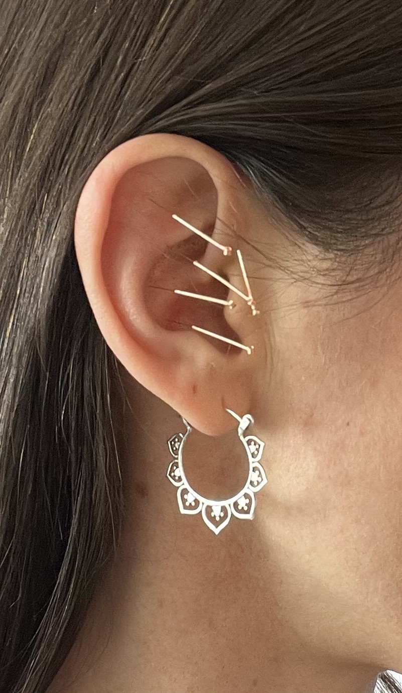 ear-acupuncture-2